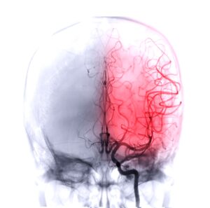 brain injury claim in Scotland